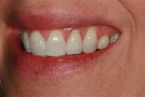 Canine Tooth After Crown Replacement