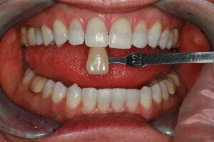 Tetracycline Stains On Teeth After Deep Bleaching