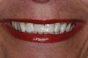 Set Of Teeth After Deep Bleaching