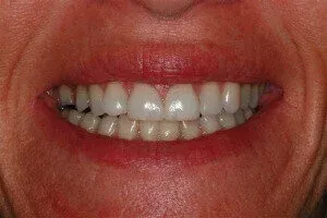 Photo of teeth showing them after dental veneers