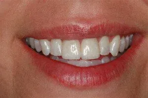 Photo of teeth showing them after the application of dental veneers