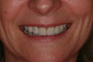 Teeth after the application of dental veneers