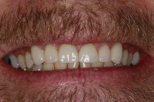 Set of nicely repaired teeth after veneers