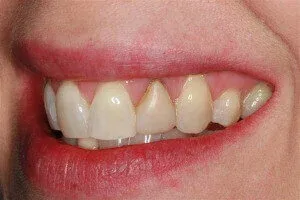 Canine Tooth Before Crown Replacement