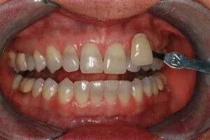Tetracycline Stains On Teeth Before Deep Bleaching