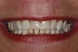 Set Of Teeth Before Deep Bleaching