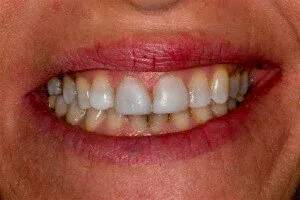 Photo of teeth showing them before dental veneers