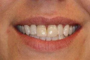 Photo of teeth showing them before the application of dental veneers