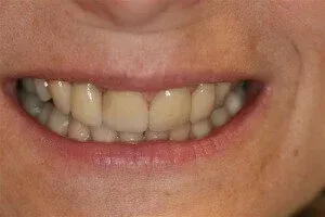 Teeth before the application of dental veneers