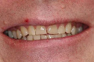 Set of Yellowed and worn teeth Before Veneers